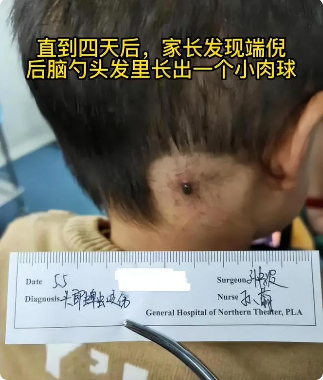 4岁孩子被蜱虫咬伤妈妈一个果断处理被医生称赞：做得好(图2)