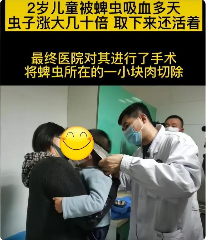 4岁孩子被蜱虫咬伤妈妈一个果断处理被医生称赞：做得好(图3)