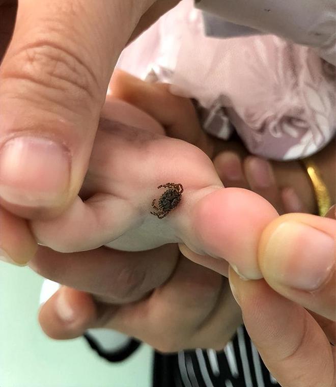 4岁孩子被蜱虫咬伤妈妈一个果断处理被医生称赞：做得好(图6)