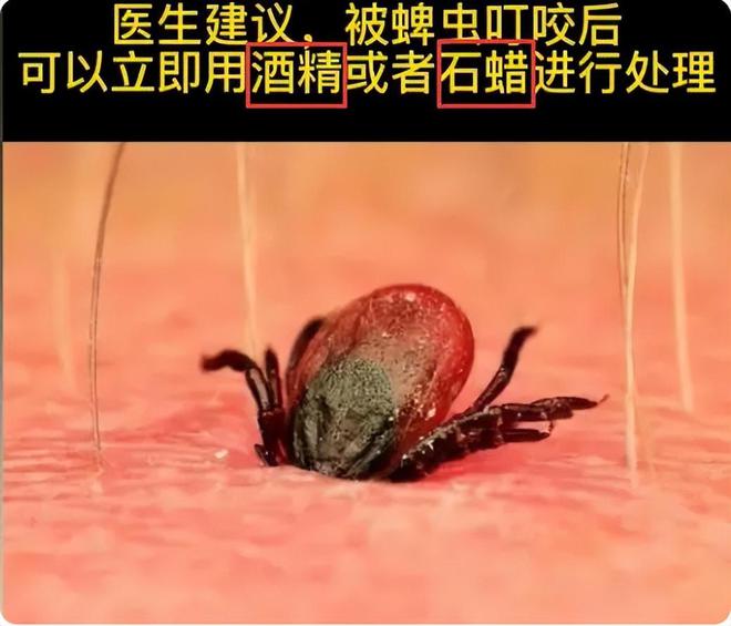 4岁孩子被蜱虫咬伤妈妈一个果断处理被医生称赞：做得好(图7)